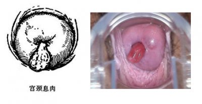 宫颈息肉手术治疗