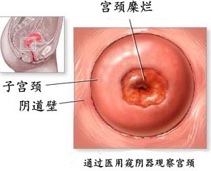 宫颈糜烂